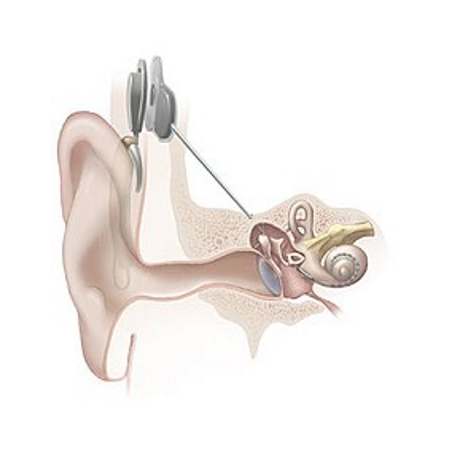 Cochlea Implant