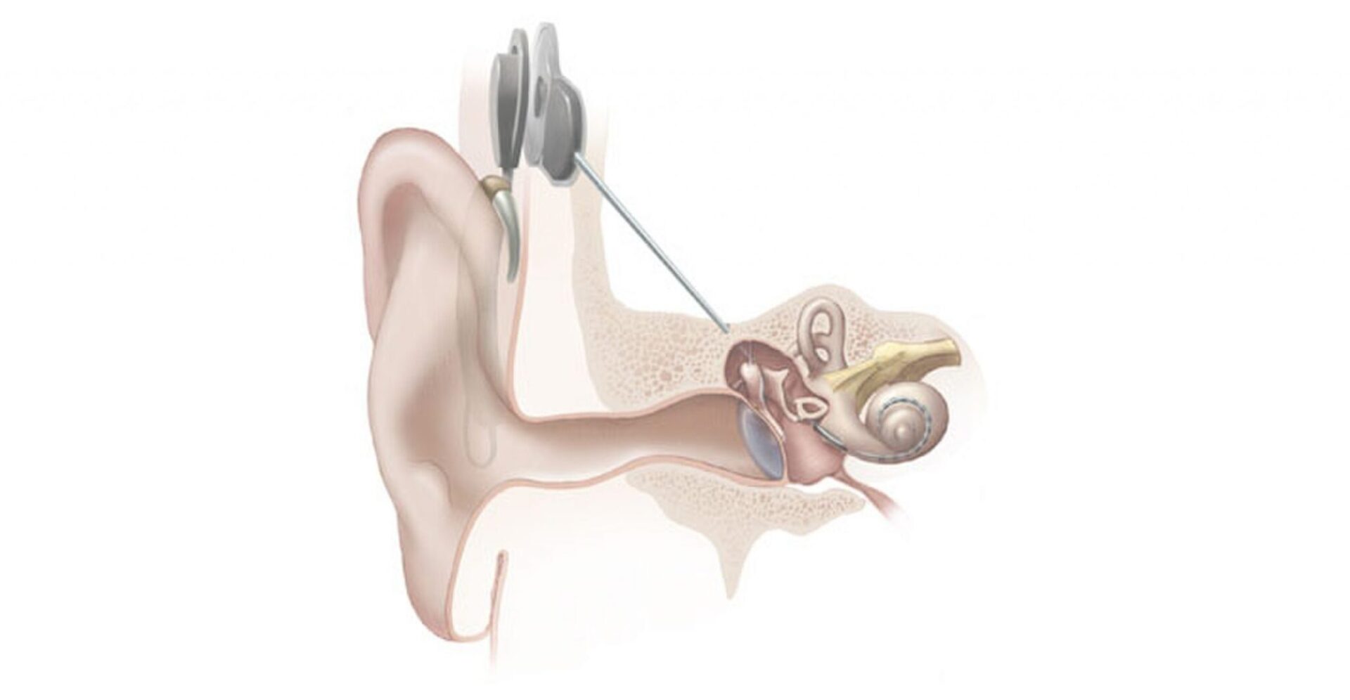 Big data for better hearing